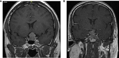 Pituitary carcinoma - case series and review of the literature